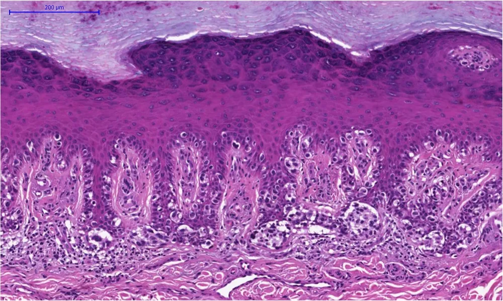 ภาพกล้องจุลทรรศน์แสดงเซลล์มะเร็งผิวหนังชนิด Melanoma ในชั้นเนื้อเยื่อ — วัคซีน mRNA มุ่งเป้าทำลายเซลล์ลักษณะนี้ที่อาจหลงเหลือหลังผ่าตัด (ภาพ: Wikimedia Commons — CC)